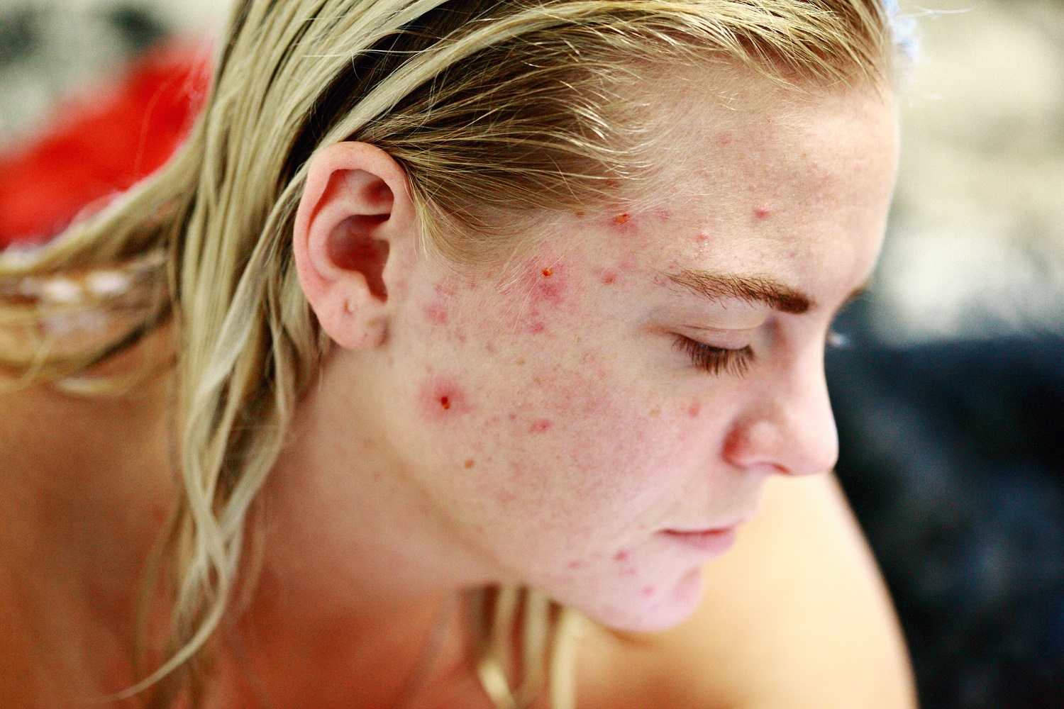 8 remedios caseros para el acné remedios_acne
